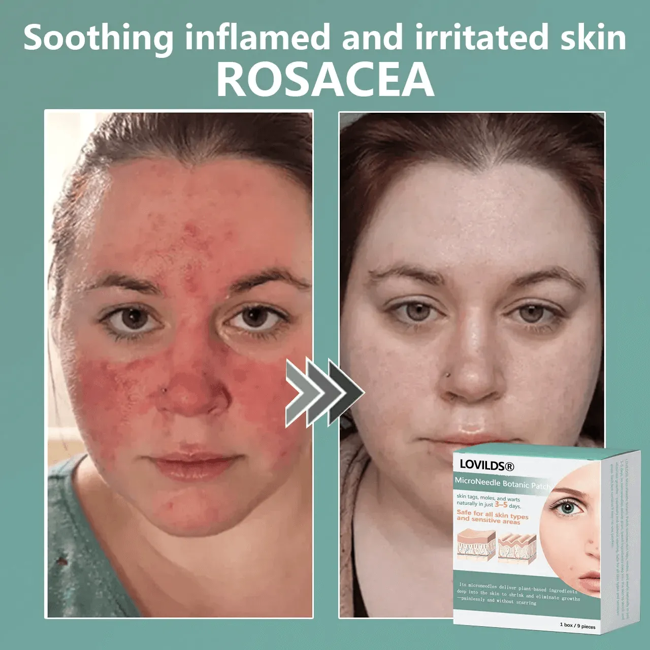 🔥Final 3 Hours: 80% OFF - LOVILDS™ Magnesium MicroNeedle Quick Remove Skin Tag Patches