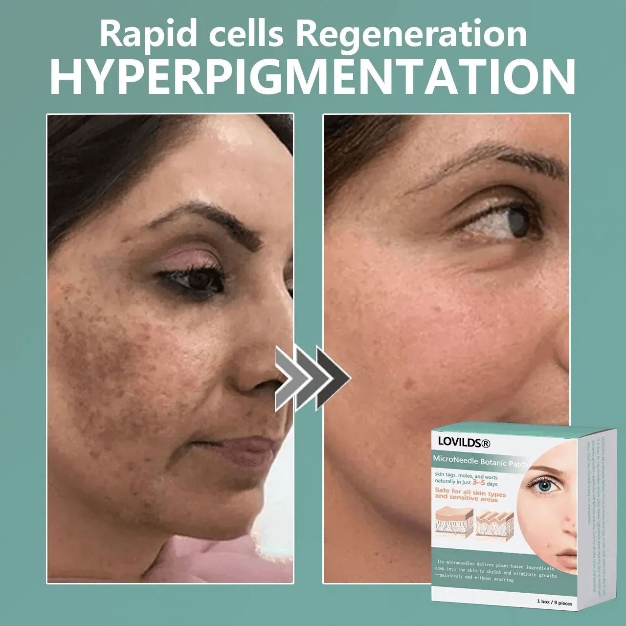 🔥Final 3 Hours: 80% OFF - LOVILDS™ Magnesium MicroNeedle Quick Remove Skin Tag Patches